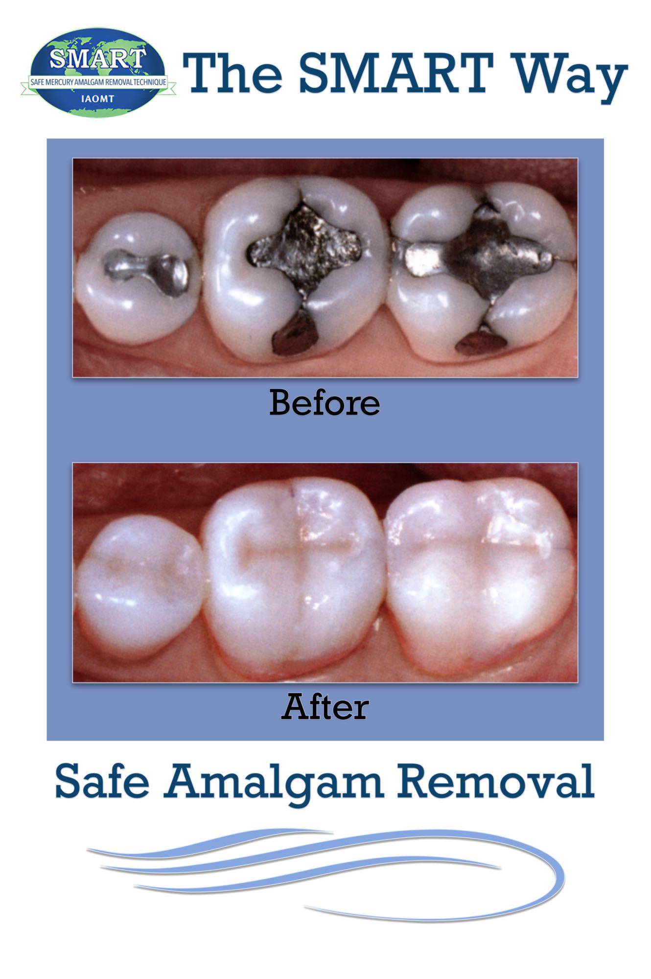 Safe Amalgam Removal