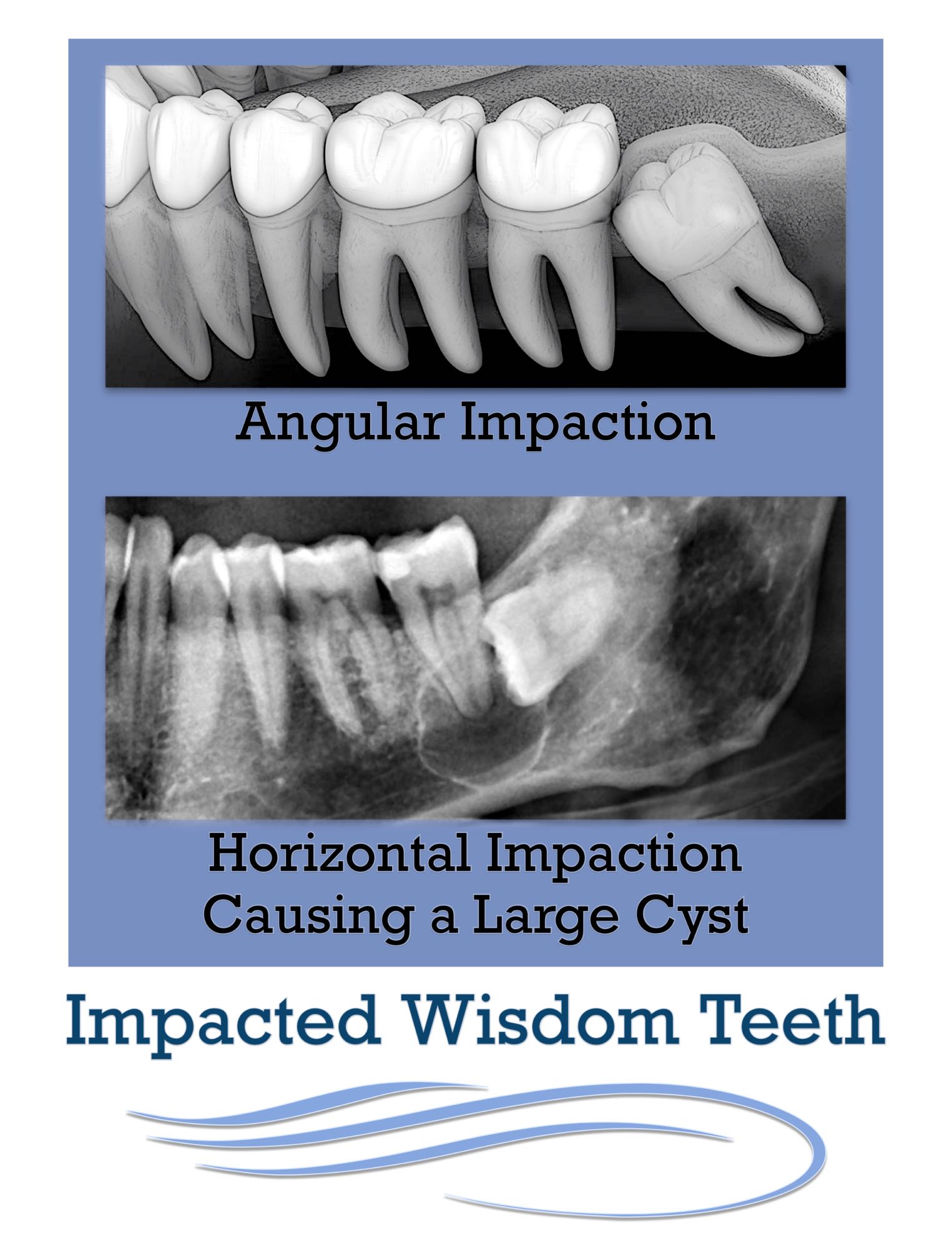 Impacted Wisdom Teeth