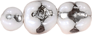 Amalgam fillings