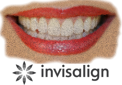 Invisalign Smile